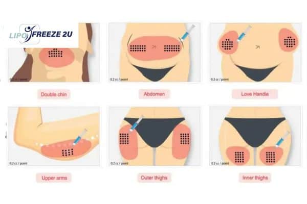 Benefits of Choosing Aqualyx for Fat Reduction Bedfordshire
