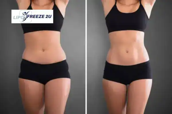 How Can LIPO FREEZE 2U Support Your Post-Pregnancy Body Recovery Bedfordshire?