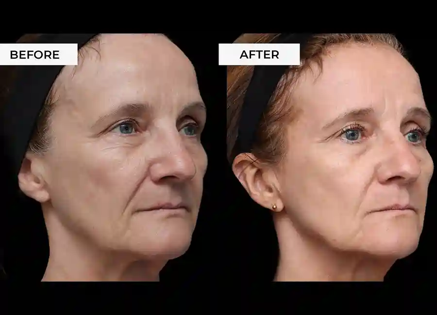 How Many RF Microneedling Sessions Will You Need to See a Difference Bedfordshire?