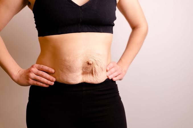 Is Surgery Really the Only Way to Repair Diastasis Recti Bedfordshire?