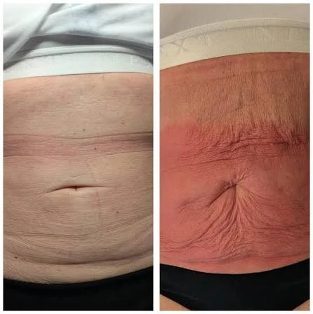 How Does RF Microneedling Improve Crepey, Thin and Uneven Skin Texture Bedfordshire?