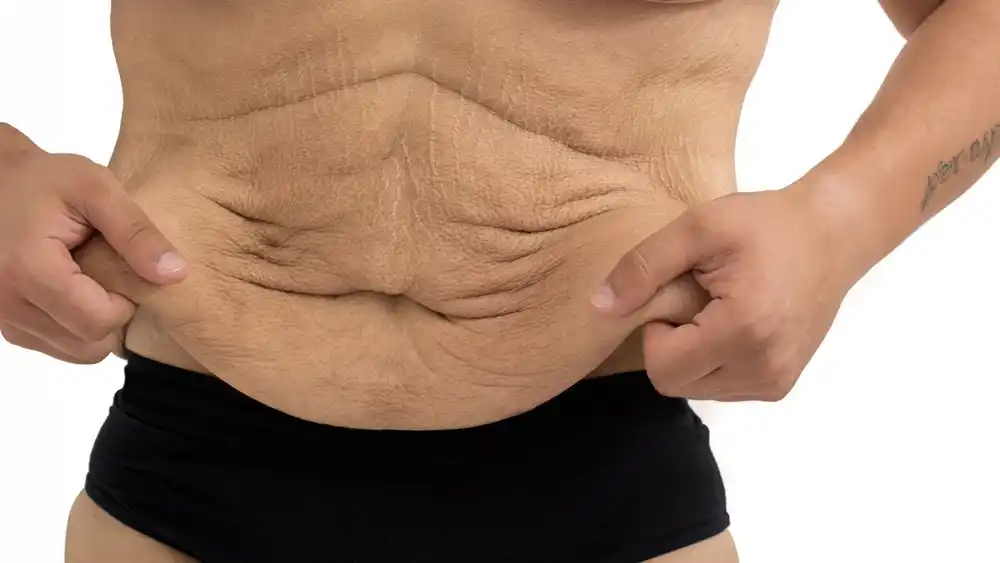 Why Does Weight Loss Medication Leave Some People With Loose or Sagging Skin Bedfordshire?